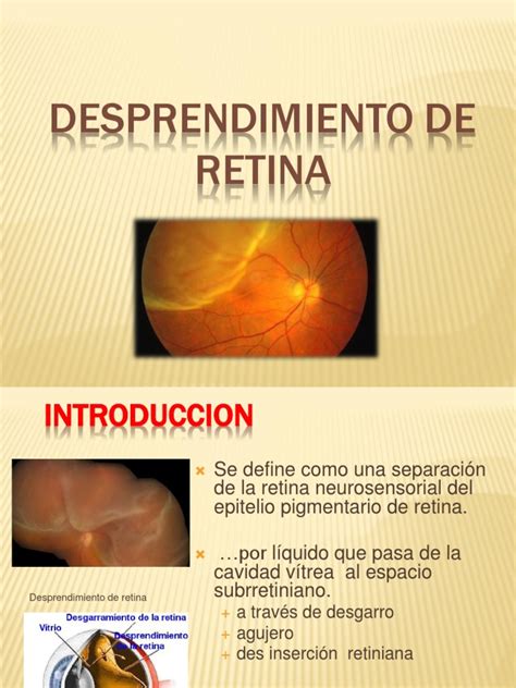 desprendimiento de retina oftalmología medicina clinica
