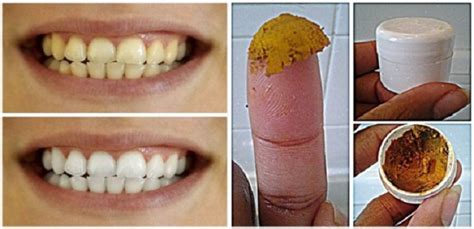 Home Remedy Be Your Own Dentist Heal Cavities Gum Disease And