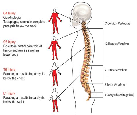 Paraplegia Injury Spinal Cord Injury Nursing Spinal Cord Injury