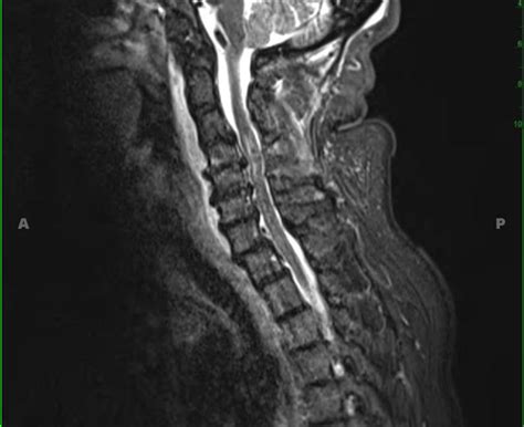 Incomplete Spinal Cord Injuries Spine Orthobullets Hot Sex Picture
