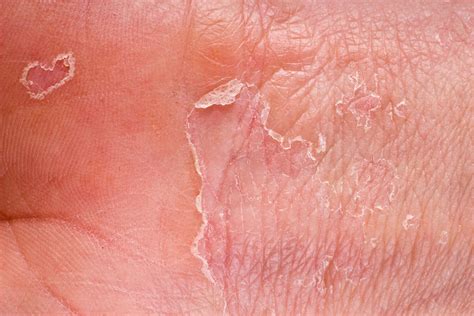 Dyshidrotic Eczema Causes Symptoms And Home Treatments Mega Bored
