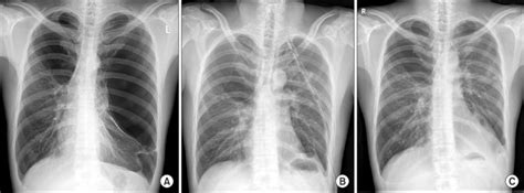 Representative Chest Radiographies A Bilateral Giant Bullae