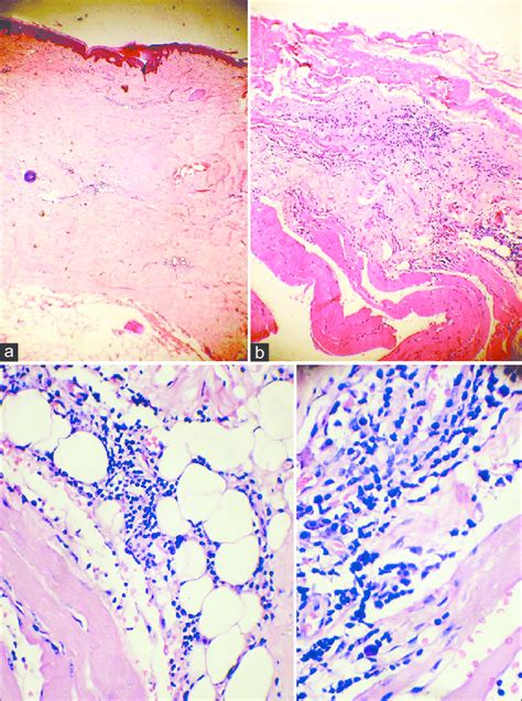 Histopathology Of The Indurated Area Revealing Features Of Eosinophilic