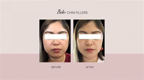 Instant Face Slimming In 5 Minutes Belo Medical Group