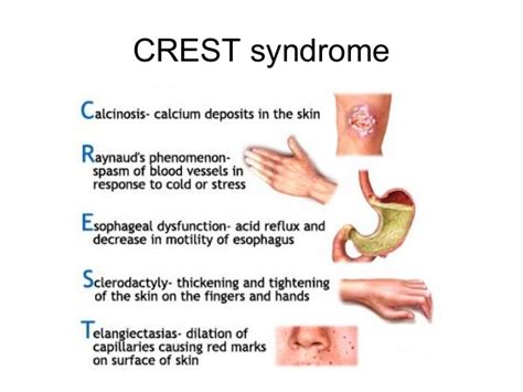 Crest Syndrom Med Kom
