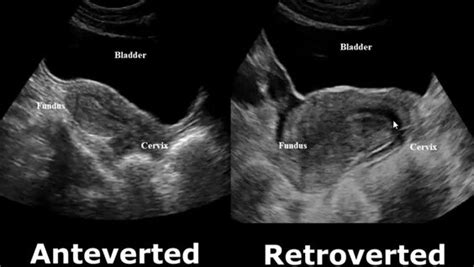 Uterine Positions In Ultrasound Antevertedretroverted Anteflexed
