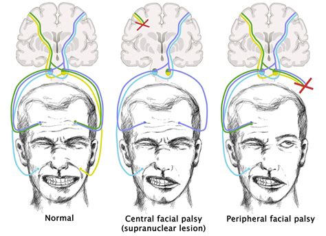 Facial Nerve Palsy Causes Symptoms Treatment Facial N