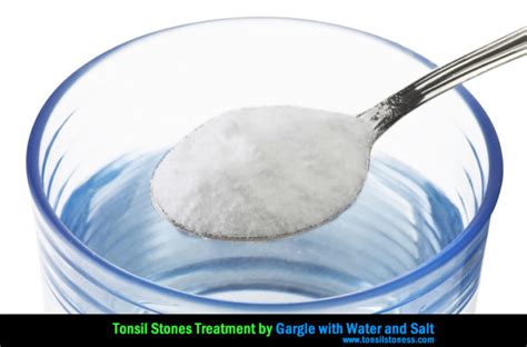 7 Natural Home Remedies To Cure Tonsil Stones 2022
