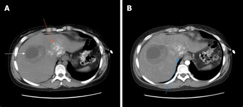 The Second Case Of Abdominal Enhancement Computed Tomography A The Download Scientific