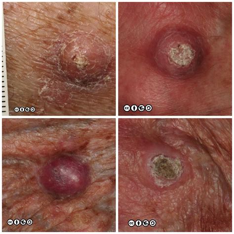 Squamous Cell Carcinoma Skin Cancer 909