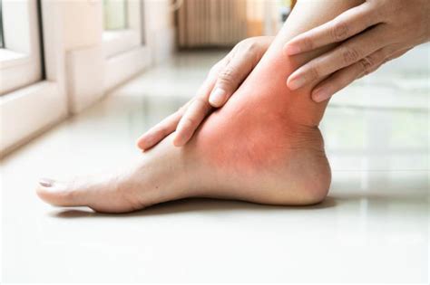 Ankle Discoloration Causes And Treatment Options Clement Banda Md