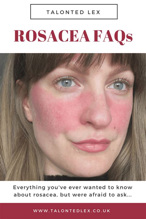 Rosacea Faq Everything Youve Ever Wanted To Know But Were Afraid To Ask Tips Advice Product