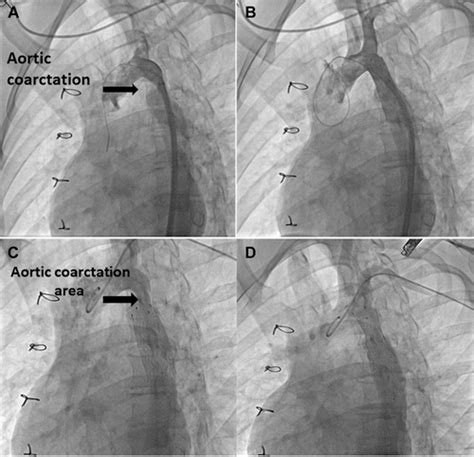Delayed Displacement Of Aortic Coarctation Stent Jacc Cardiovascular