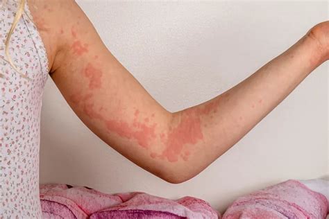 What Causes Hives And How Dangerous Can They Be A Nurse Practitioner Explains