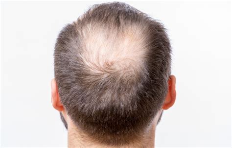 Alopecia areata may be hereditary and isn't contagious. Alopecia: conheça os vários tipos de perda de cabelo
