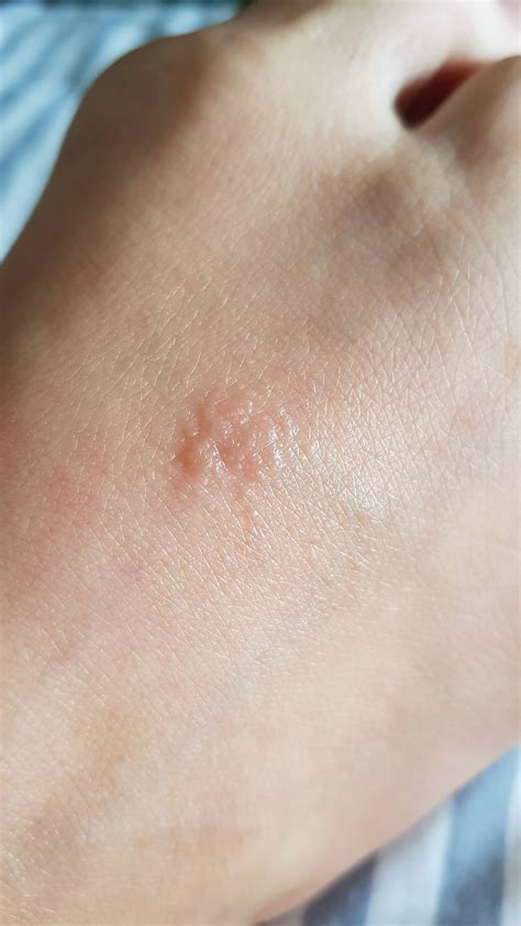 Ive Got A Itchy Rash Recently On My Foot But Im Not Sure What Is It