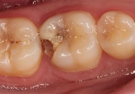 Broken Tooth Or Cracked Teeth Windsor Dentists
