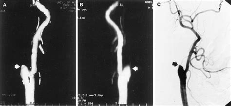 CT Angiography For The Detection And Characterization Of Carotid Artery