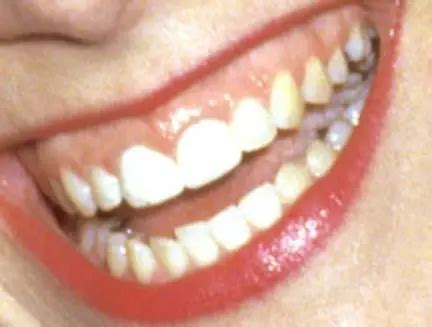 Katie Couric Teeth Pictures