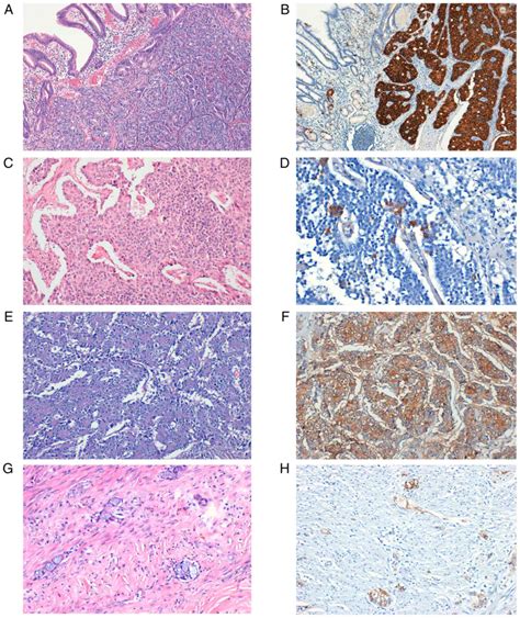 The New Who Classification Of Gastrointestinal Neuroendocrine Tumors