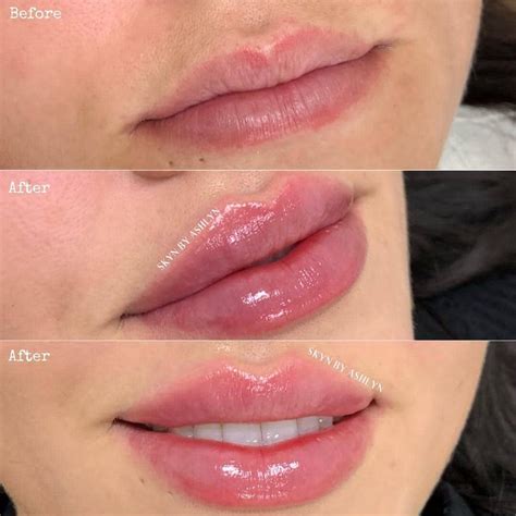 best of cosmetic dermatology on instagram “before after lip filler details below