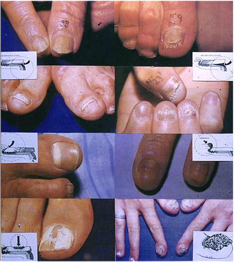 Diseases Mimicking Onychomycosis Clinics In Dermatology