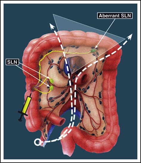 Aberrant Drainage Of Sentinel Lymph Nodes In Colon Cancer And Its