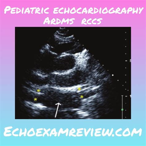 Pediatric Echocardiography Review Ardmsrccs What Is The Arrow Pointing