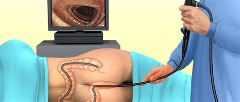 Although many private insurance plans cover the costs for colonoscopy as a screening test, you still might be charged for some services. Colonoscopy Treatment in Thane | Colonoscopy Surgery in Thane | Currae Hospital