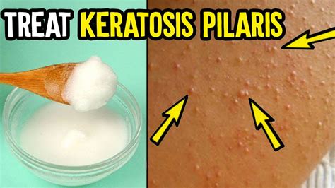 How To Treat Keratosis Pilaris Chicken Skin Best Keratosis Pilaris