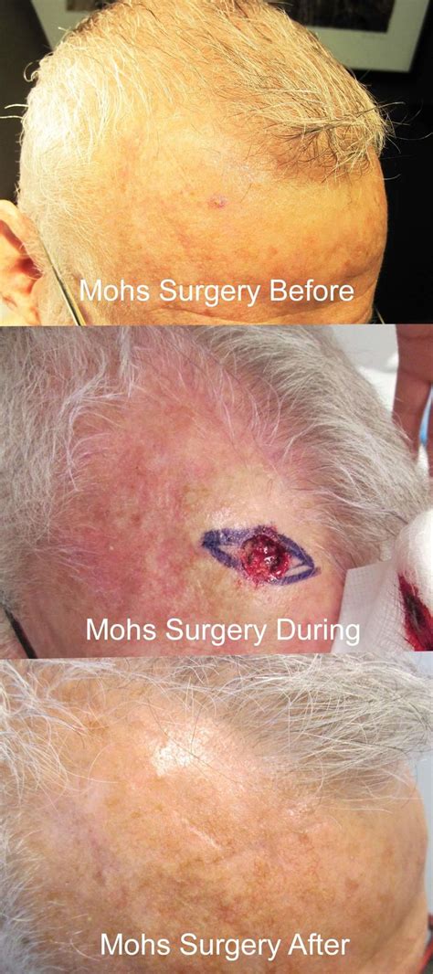 Skin Cancer Mohs Surgery
