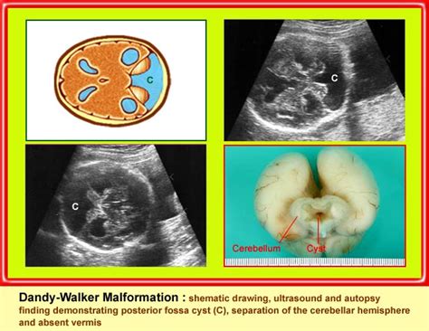 Dandy Walker Malformation Department Of Obstetrics And Gynecology