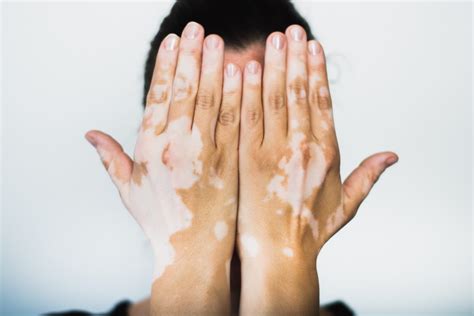 Vitiligo Proving Beauty Is Not Just Skin Deep Scientific Scribbles
