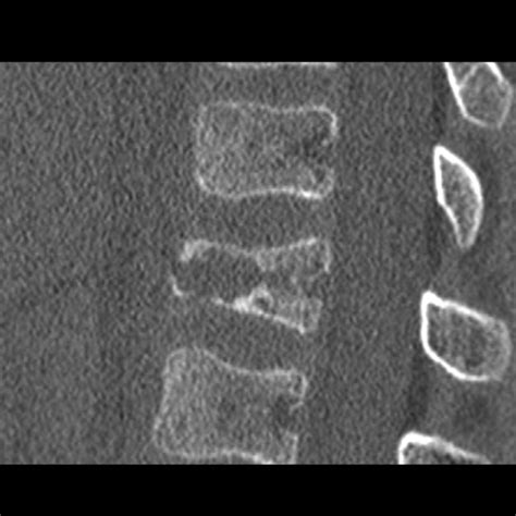 Eosinophilic Granuloma Spine Image