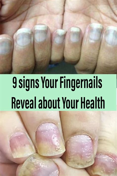 9 Signs Your Fingernails Reveal About Your Health Nail Problems