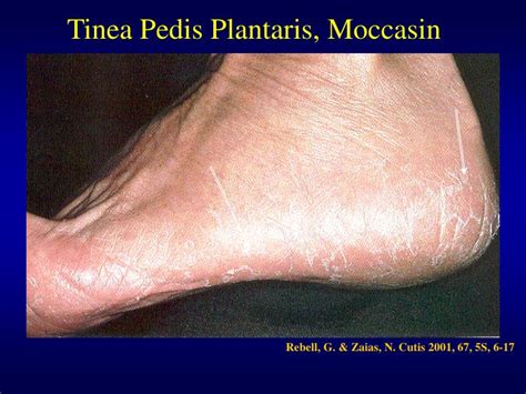 Ppt Tinea Pedis Natural History And Clinical Trials Powerpoint