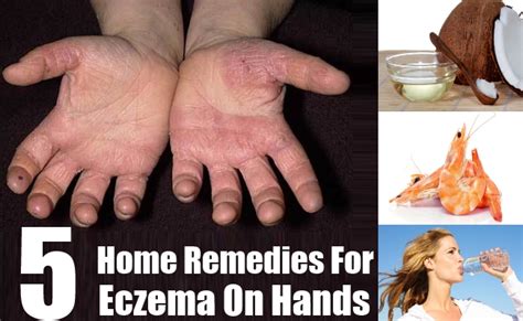 5 Best Home Remedies For Eczema On Hands Natural Home Remedies