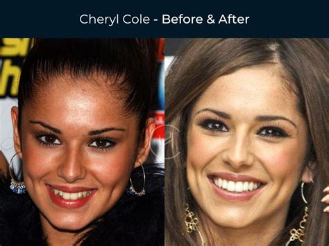 Celebrity Dental Implants And Veneers Before And After Photos