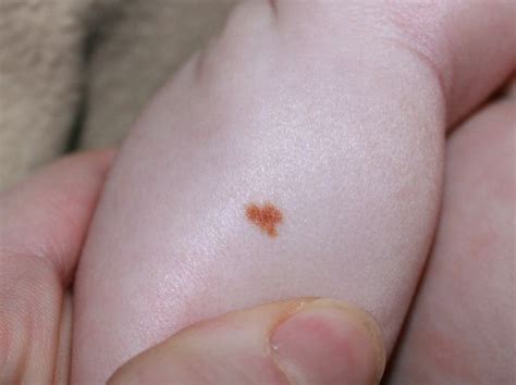 Small Birthmark With A Highly Contrasting Color To Skin Irregularly