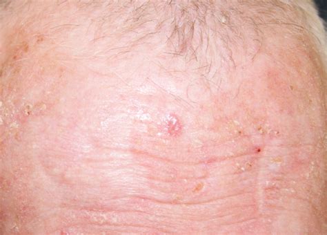 Basal Cell Cancer Bcc Skin Repair