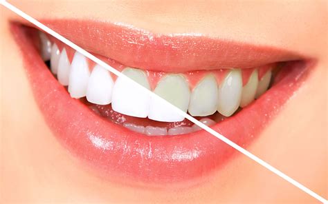 Brighten Your Smile A Comprehensive Guide To Teeth Whitening The Red