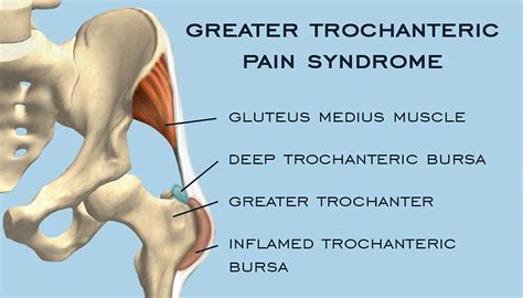 Causes Of Outside Hip Pain