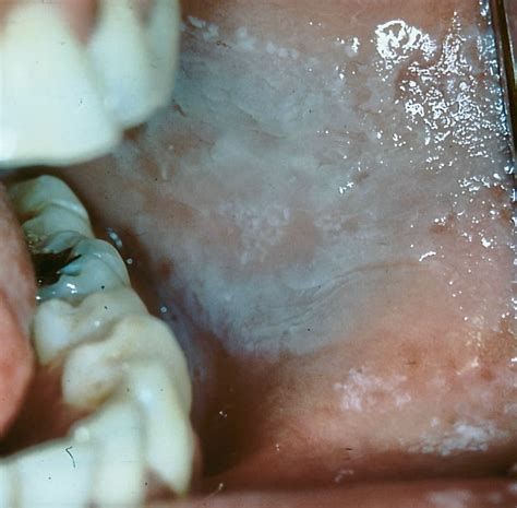 Benign Chronic White Lesions Of The Oral Mucosa Statpearls Ncbi