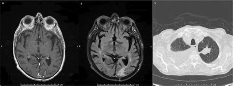 A 6 Mm 2 Metastasized Brain Tumor In Left Occipital Lobe B Swelling