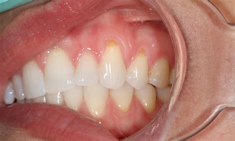A bump on gums usually appears after a tooth extraction. Pinhole Gum Recession Treatment | Brentwood TN Dentist