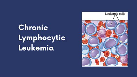 Ikris Pharma Blog Chronic Lymphocytic Leukemia Causes Symptoms