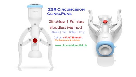 Stitchless Zsr Circumcision