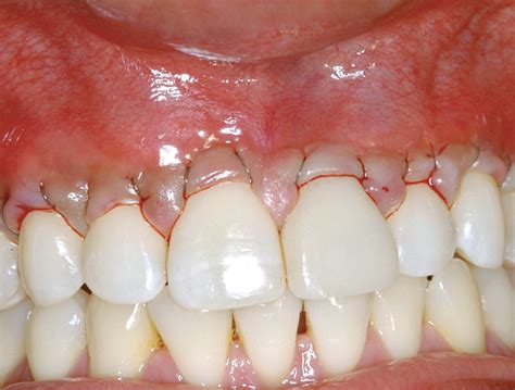 What Are The Benefits Of Gum Grafting