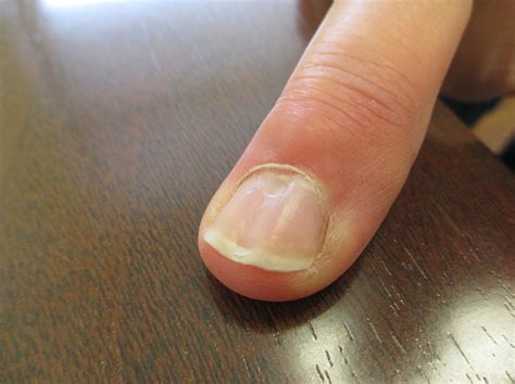 An Atlas Of Nail Disorders Part 7 Consultant360