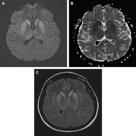 Imaging Of Cerebritis Encephalitis And Brain Abscess Neuroimaging